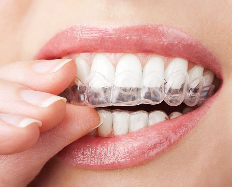 invisalign example
